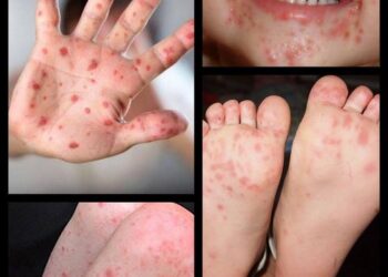 Şimdi de ‘el, ayak ve ağız hastalığı’ hortladı!