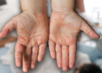 Bakan Koca: Kızamığa bağlı ölüm yalan, vaka artı gerçek