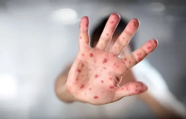 'Kızamık vakalarındaki artışın en önemli sebebi aşı karşıtlığı' 1 ‘Kızamık vakalarındaki artışın en önemli sebebi aşı karşıtlığı’