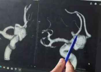 Anevrizma hakkında yeni araştırma: Hangi yırtılma riskinin daha yüksek olduğu belirlendi 1 Anevrizma hakkında yeni araştırma: Hangi yırtılma riskinin daha yüksek olduğu belirlendi