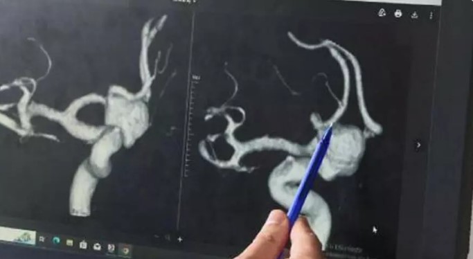 Anevrizma hakkında yeni araştırma: Hangi yırtılma riskinin daha yüksek olduğu belirlendi 1 Anevrizma hakkında yeni araştırma: Hangi yırtılma riskinin daha yüksek olduğu belirlendi