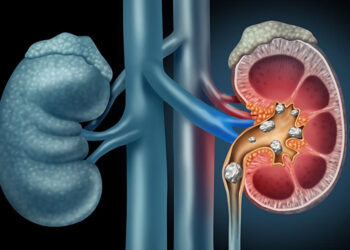 Fazla C vitamini böbrek taşını oluşturuyor