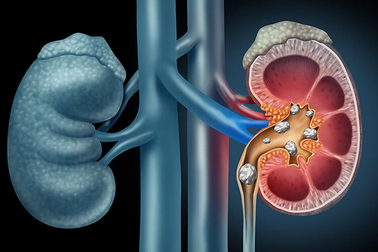 Fazla C vitamini böbrek taşını oluşturuyor