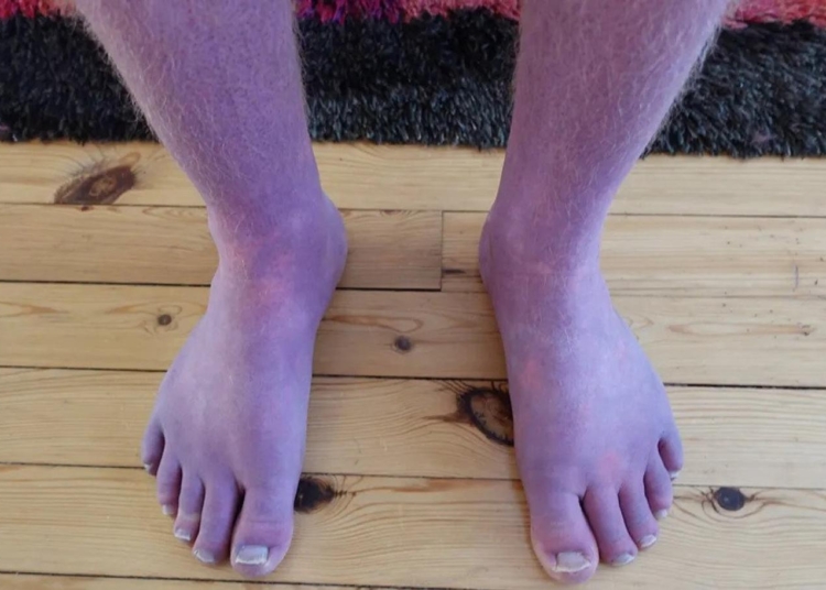 Uzun Kovid geçiren genç adamın bacakları mora döndü 1 Uzun Kovid geçiren genç adamın bacakları mora döndü