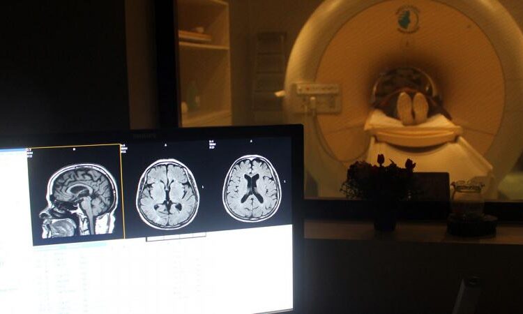 80 yıl boyunca beynine saplanan iğneyle yaşadı 1 80 yıl boyunca beynine saplanan iğneyle yaşadı