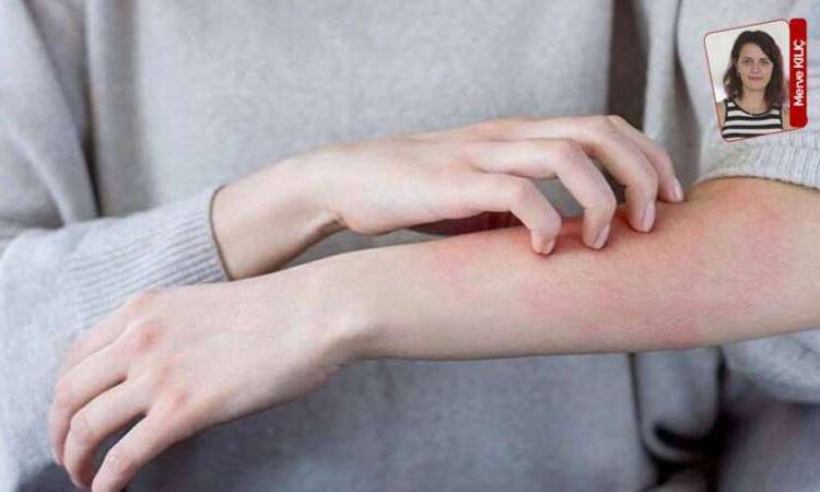 Uyuz alarmı: Krem ve losyonlar fayda etmiyor