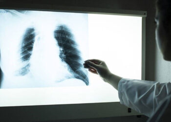 Tedavi edilmeyen ‘varis’ akciğer embolisine neden olabilir