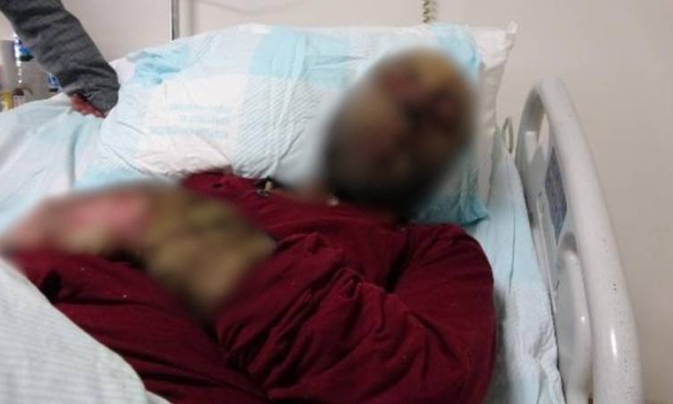 Milyonda 3 kişide görülen hastalık Türkiye'de: Yüzü tanınmaz hale geldi 1 Milyonda 3 kişide görülen hastalık Türkiye’de: Yüzü tanınmaz hale geldi