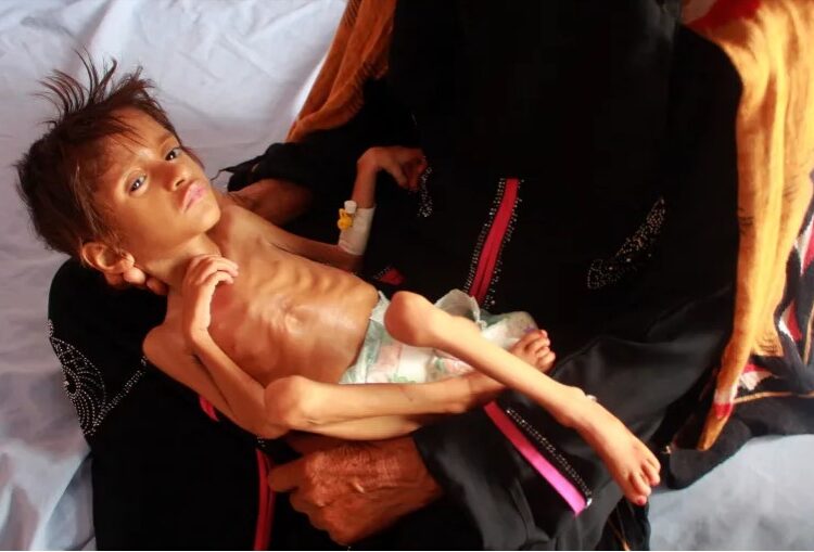 وباء الكوليرا يهدد اليمن من جديد