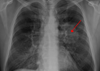 إحياء آمال مرضى سرطان الرئة بعلاجات أكثر تطورا 5 إحياء آمال مرضى سرطان الرئة بعلاجات أكثر تطورا