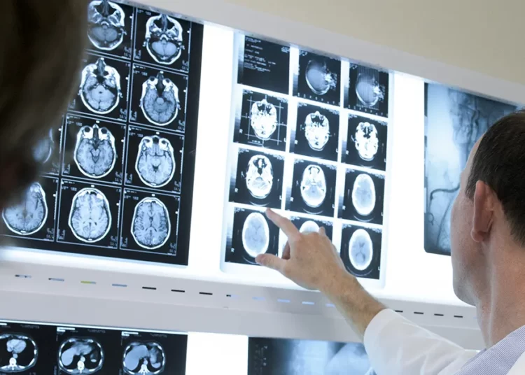 Alzheimer'ı yavaşlatan ikinci ilaç ABD'de onay başvurusunda bulundu 1 Alzheimer’ı yavaşlatan ikinci ilaç ABD’de onay başvurusunda bulundu