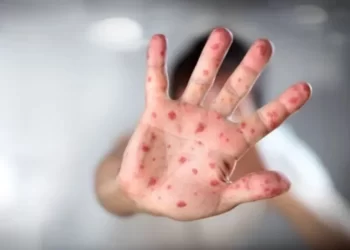 ‘Kızamık vakalarındaki artışın en önemli sebebi aşı karşıtlığı’