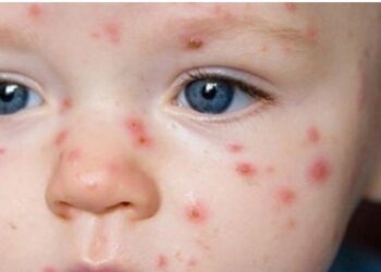 Kızamık vakalarının en yaygın olduğu 5 ilin birincisi İstanbul