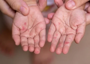 Kızamık vakaları 30 kat arttı, DSÖ acil önlem çağrısı yaptı