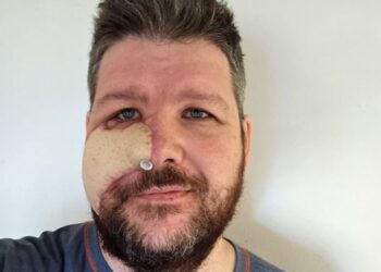 Yüzünü parçalayan ayıyı kebap yapıp yedi