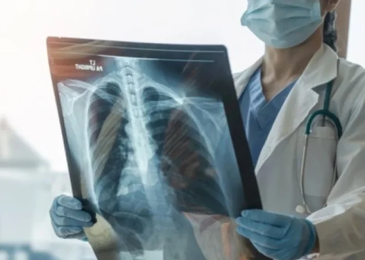 Korkutan rakam! Türkiye’de her yıl 41 bin kişi akciğer kanserine yakalanıyor