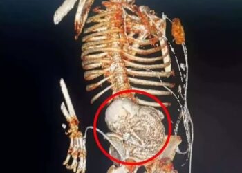 81 yaşındaki kadın 56 yıl karnındaki “taş bebek”le yaşamış