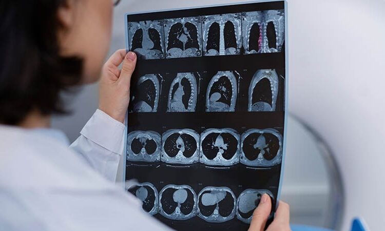 Bilim insanlarından çığır açacak keşif: Alzheimer riskini düşürecek gen bulundu! 1 Bilim insanlarından çığır açacak keşif: Alzheimer riskini düşürecek gen bulundu!