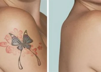 Son 5 yılda 1 milyondan fazla kişi dövmesini sildirdi