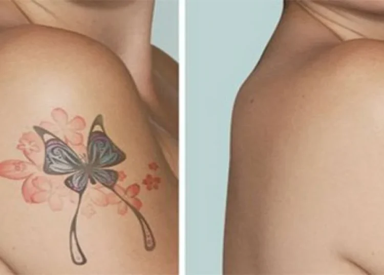 Son 5 yılda 1 milyondan fazla kişi dövmesini sildirdi