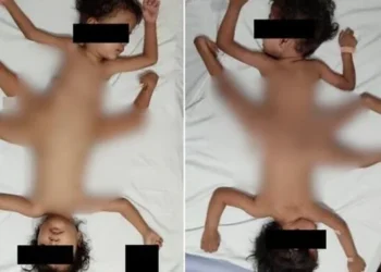 İki milyonda bir rastlanıyor: Tıp dünyası “Örümcek ikizler” hastalığı karşısında şaşkına döndü