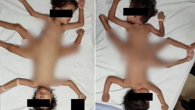 İki milyonda bir rastlanıyor: Tıp dünyası "Örümcek ikizler" hastalığı karşısında şaşkına döndü 1 İki milyonda bir rastlanıyor: Tıp dünyası “Örümcek ikizler” hastalığı karşısında şaşkına döndü