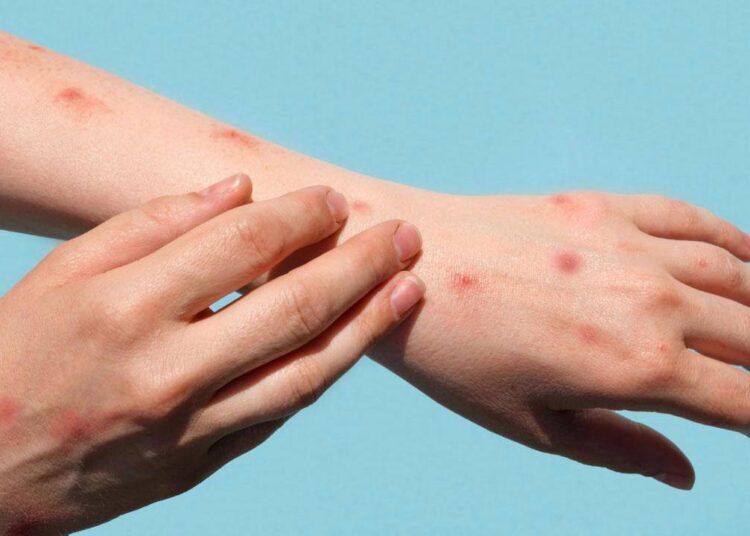 Maymun çiçeği virüsü Avrupa’ya sıçradı