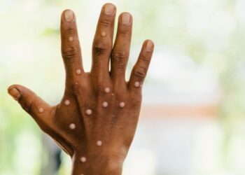 5 soruda Covid ile M çiçeği arasındaki farklar 4 5 soruda Covid ile M çiçeği arasındaki farklar