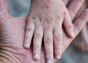 Kızamıkta vaka sayılarındaki artış korkutuyor: 27 yıl sonra en yüksek sayıya ulaştı