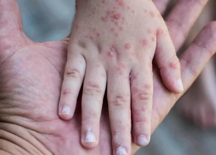 Kızamıkta vaka sayılarındaki artış korkutuyor: 27 yıl sonra en yüksek sayıya ulaştı