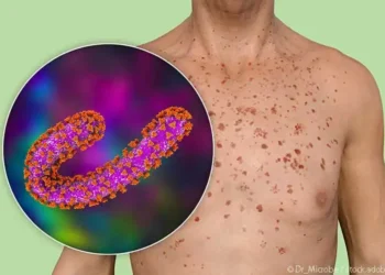 Marburg virüsü yayılıyor: Tedavisi yok, ölüm oranı yüzde 88’e kadar çıkıyor