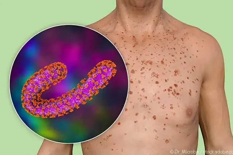 Marburg virüsü yayılıyor: Tedavisi yok, ölüm oranı yüzde 88’e kadar çıkıyor