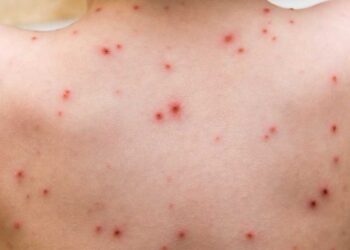 Okullarda suçiçeği salgını