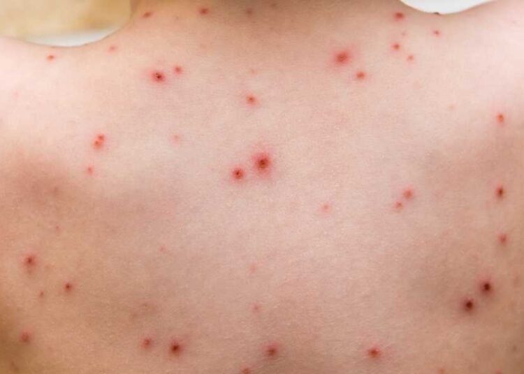 Okullarda suçiçeği salgını