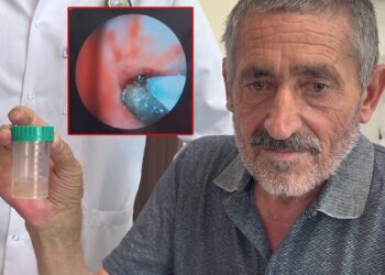 Soluk borusundan çıkan doktorları bile şaşkına çevirdi 4 Soluk borusundan çıkan doktorları bile şaşkına çevirdi